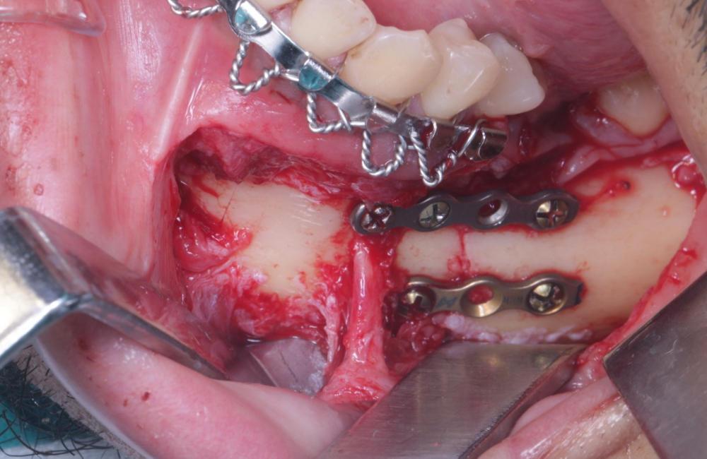 antes Corrección de fractura mandibular